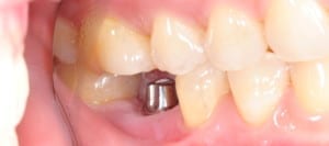 What are dental implants and why are they used to replace teeth?